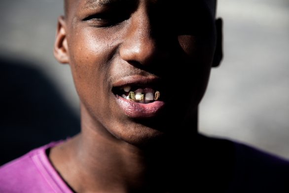 18 year old Cassidy shows off his gold plated front teeth denture.